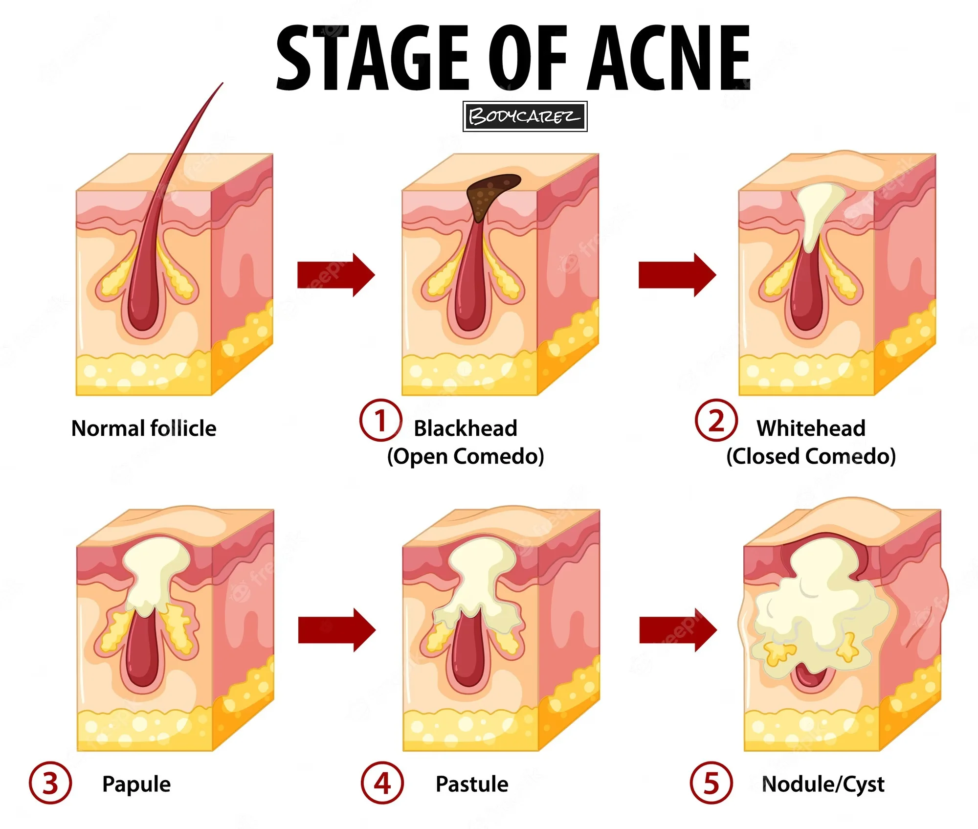Stages of a Pimple